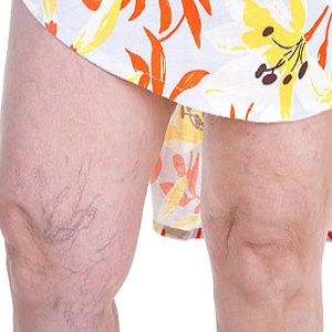 What Are Symptoms of Spider Veins?