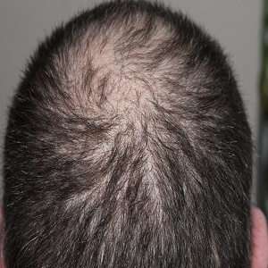 Is PRP Safe To Use For Hair Restoration?