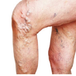 What Treatment Options are there for Varicose Veins?